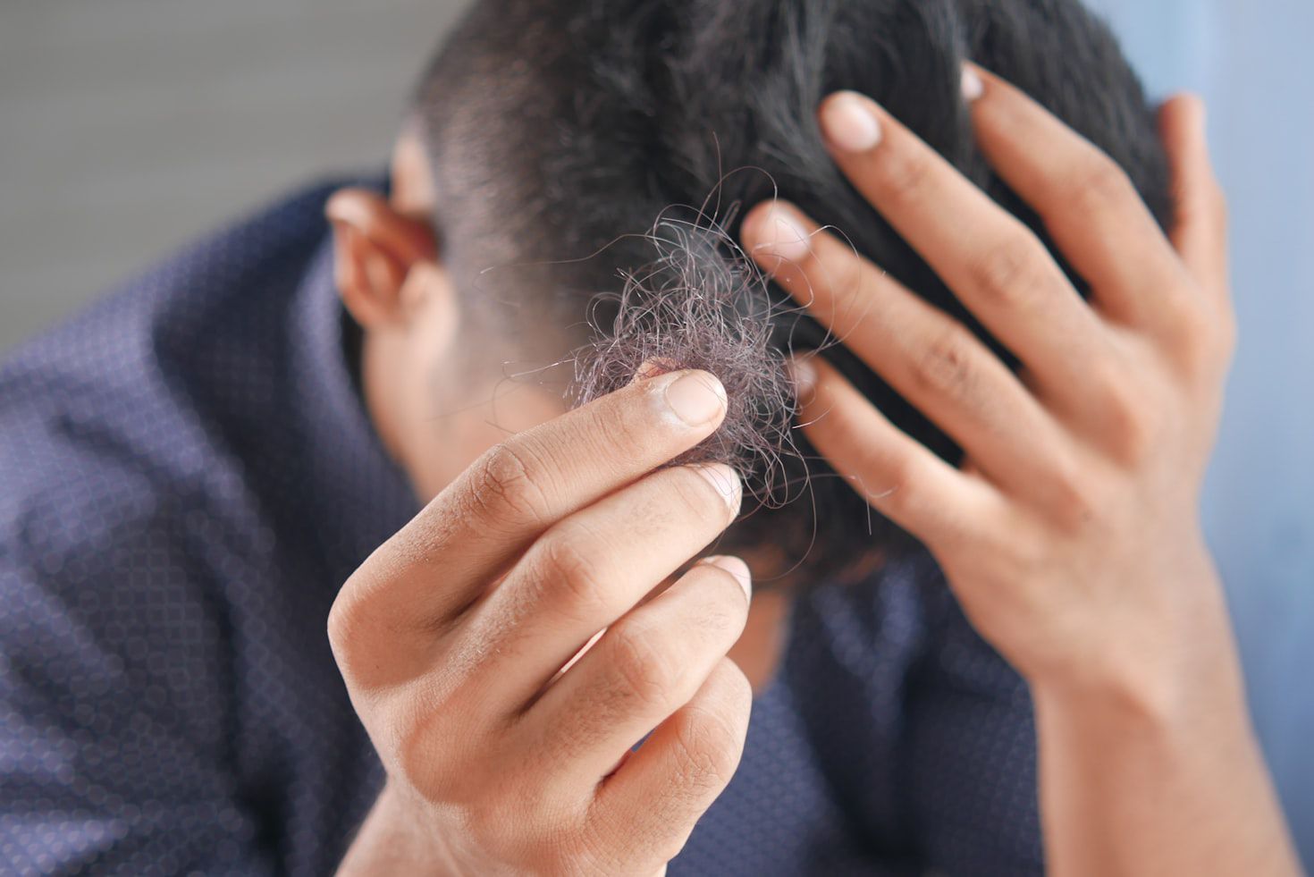The Shift in Hair Restoration