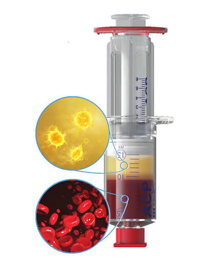 PRP Hair Treatment London