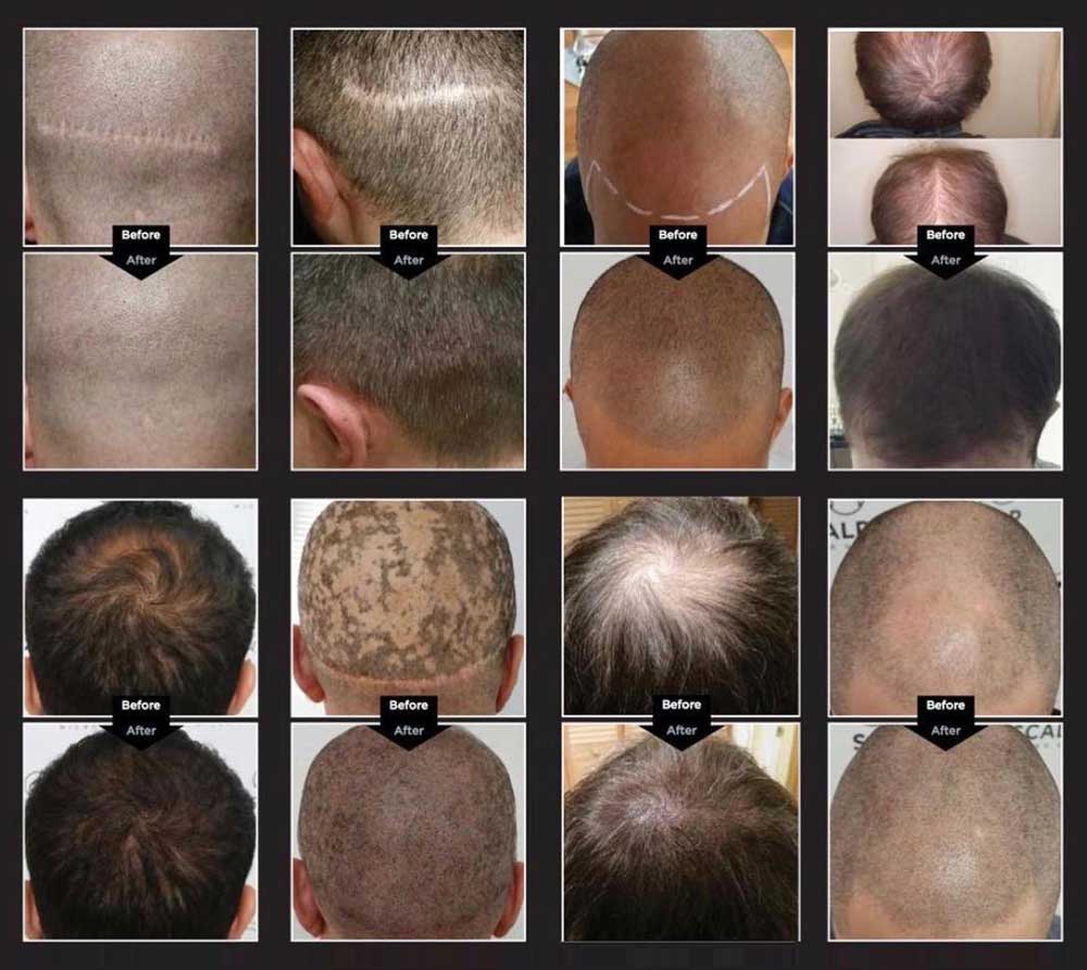 Kelly-Morrell-SMP-before-and-After-Treatments