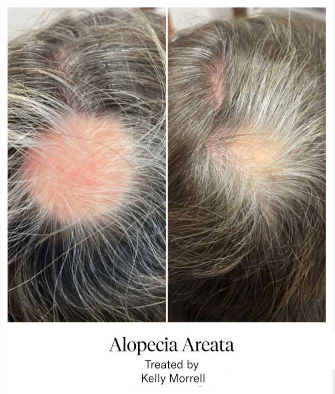 Calecim Hair treatment London