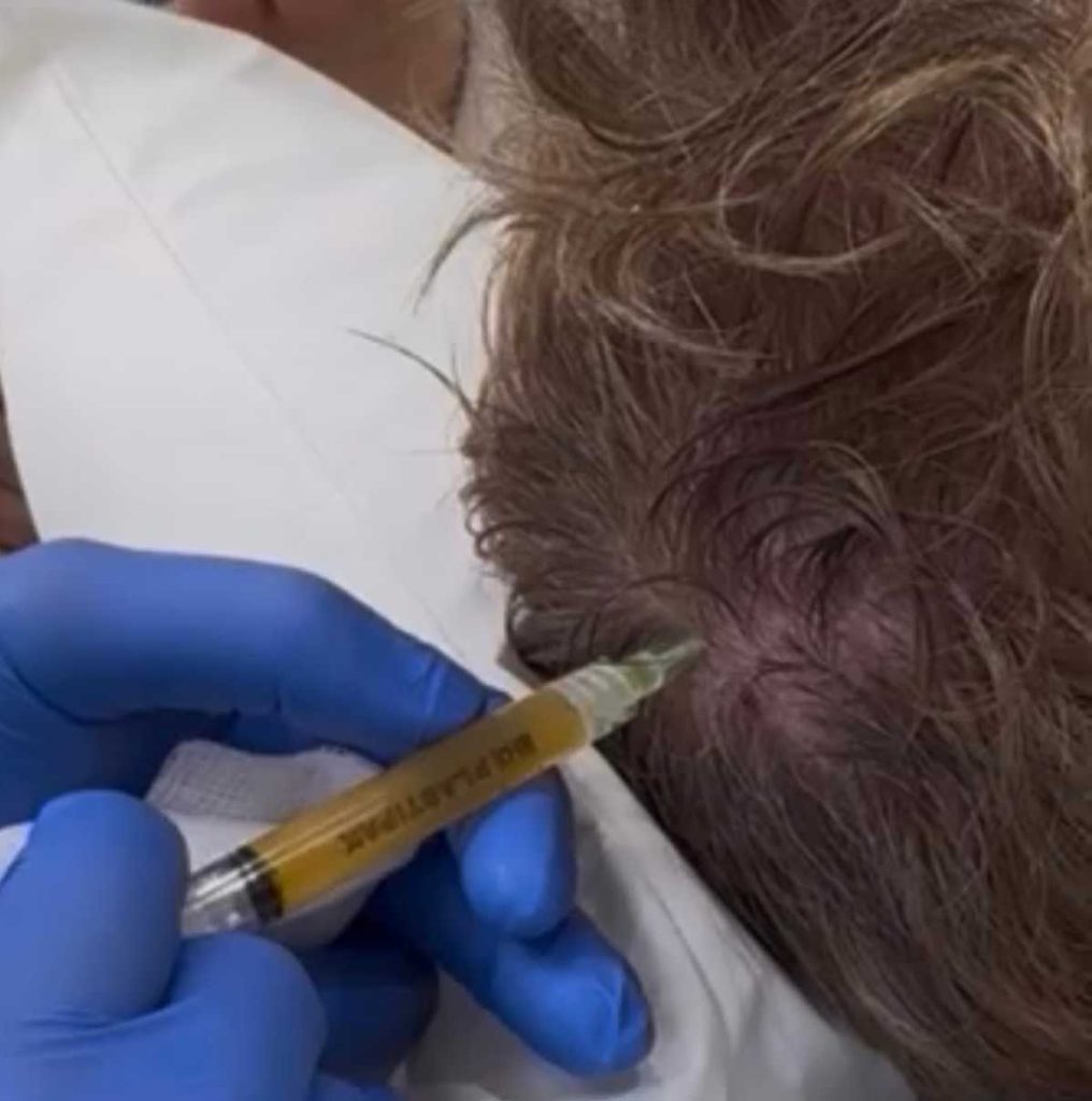PRP-treatment-on-a-Male-patient